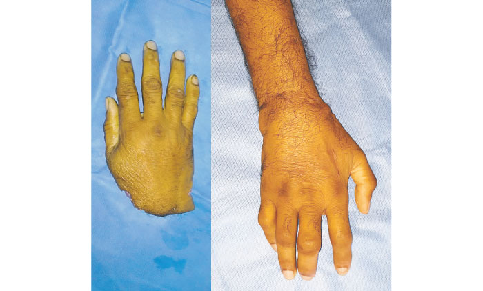 ആ വിരലുകൾ ഇനി ചലിക്കും  സ്പർശനത്തിനായി