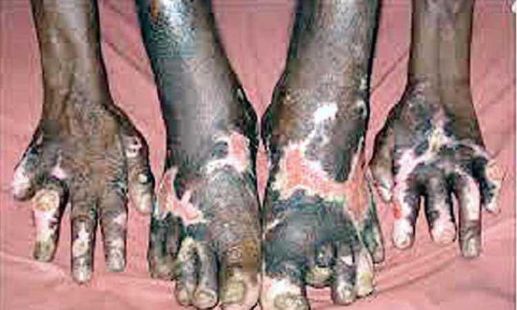 ജില്ലയിൽ 32 പേർക്ക്​ കുഷ്​ഠരോഗം