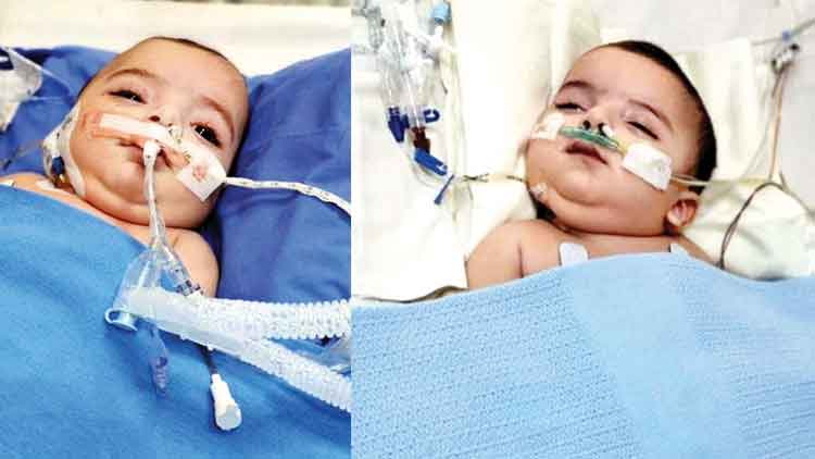 ലിബിയൻ സയാമീസ്​ ഇരട്ടകളുടെ ആരോഗ്യനില തൃപ്​തികരം