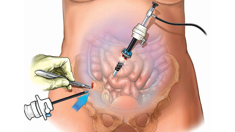 ഉദരാർബുദവും താക്കോൽദ്വാര ശസ്ത്രക്രിയയും