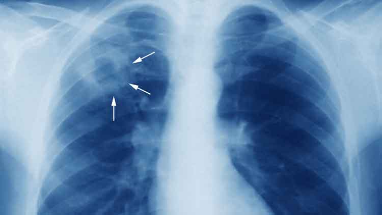 ക്ഷയരോഗനിർണയത്തിനും ചികിത്സക്കും ജില്ലതല ഹെൽപ്‌ലൈൻ