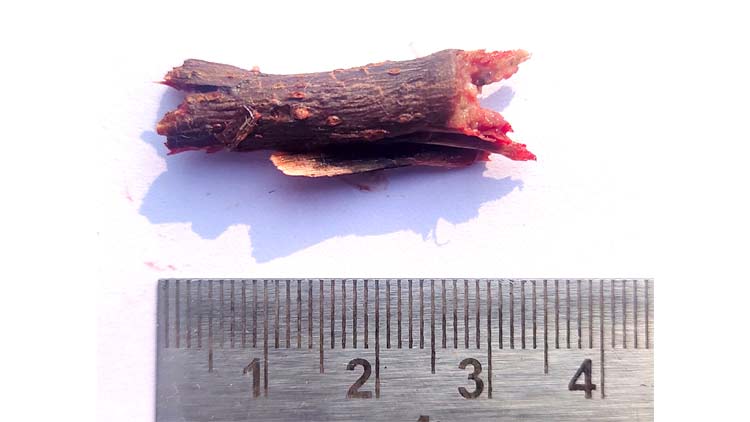 കണ്ണിൽ കരടല്ല; പുറത്തെടുത്തത്​ മരക്കഷ്​ണം