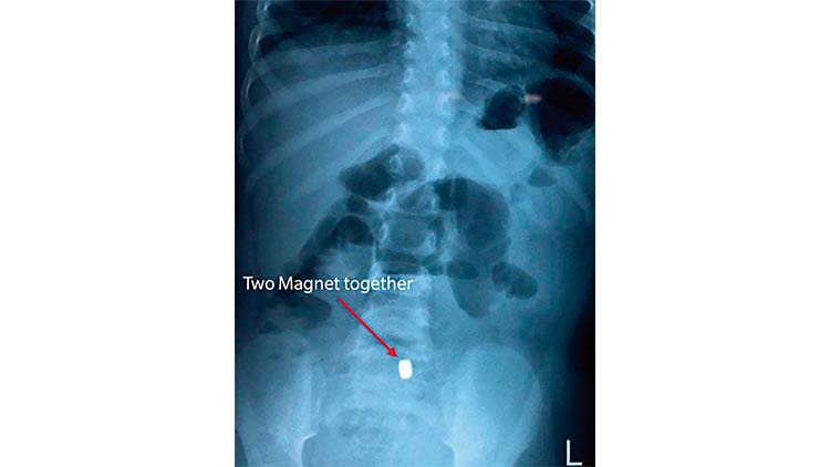 വി​ഴു​ങ്ങിയത് രണ്ട് കാന്തം; അടിയന്തര ചികിത്സക്കൊടുവിൽ ര​ണ്ടു വ​യ​സ്സു​കാ​രി ആ​​ശു​പ​ത്രി​വി​ട്ടു